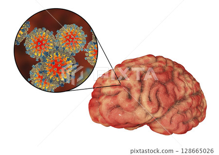 Measles-induced encephalitis, medical concept 128665026
