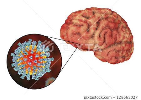 Measles-induced encephalitis, medical concept 128665027
