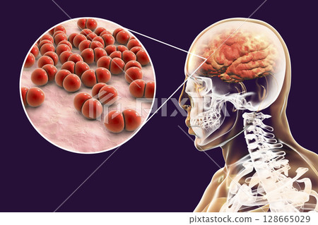 Brain infection caused by Streptococcus pneumoniae bacteria Brain infection caused by Streptococcus pneumoniae bacteria 128665029