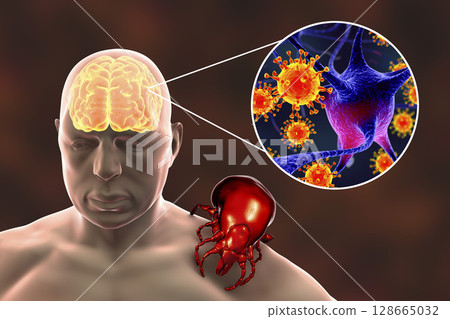 Tick-borne encephalitis concept 128665032