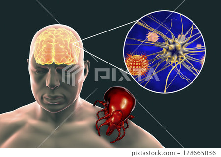 Tick-borne encephalitis concept 128665036