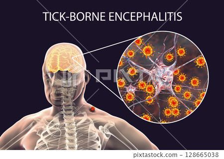Tick-borne encephalitis concept 128665038