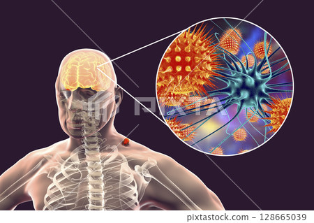 Tick-borne encephalitis concept Tick-borne encephalitis concept 128665039