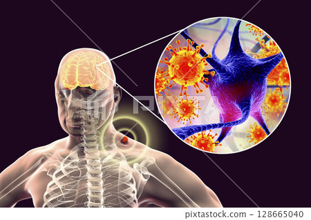 Tick-borne encephalitis concept 128665040