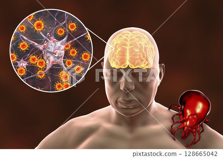 Tick-borne encephalitis concept Tick-borne encephalitis concept 128665042