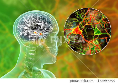 Amygdala in the brain, and closeup view of amygdala neurons, 3D illustration 128667899