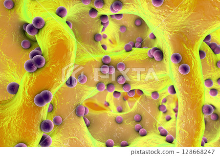 Spherical bacteria inside bone tissue Spherical bacteria inside bone tissue 128668247