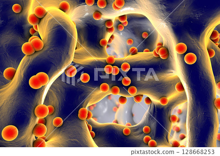 Spherical bacteria inside bone tissue 128668253