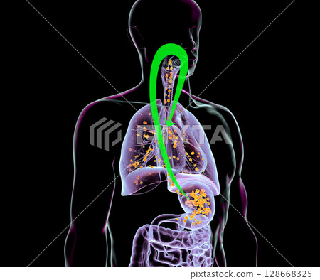 Aspiration pneumonia, 3D illustration Aspiration pneumonia, 3D illustration 128668325