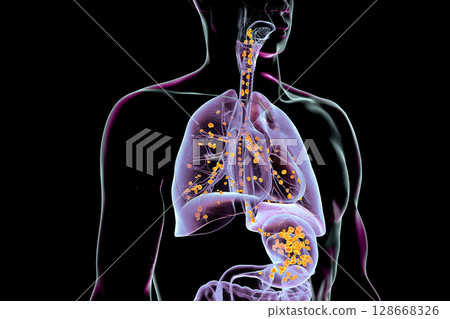 Aspiration pneumonia, 3D illustration Aspiration pneumonia, 3D illustration 128668326
