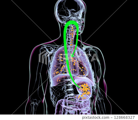 Aspiration pneumonia, 3D illustration 128668327