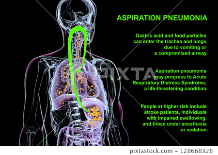 Aspiration pneumonia, 3D illustration Aspiration pneumonia, 3D illustration 128668328