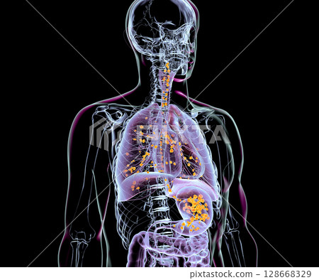 Aspiration pneumonia, 3D illustration Aspiration pneumonia, 3D illustration 128668329