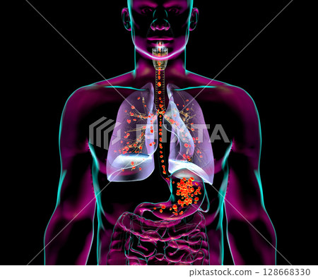Aspiration pneumonia, 3D illustration Aspiration pneumonia, 3D illustration 128668330