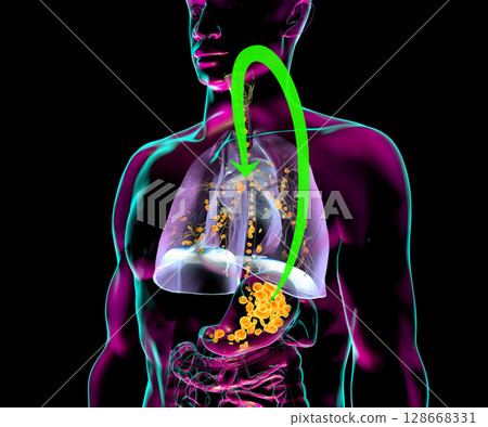 Aspiration pneumonia, 3D illustration 128668331