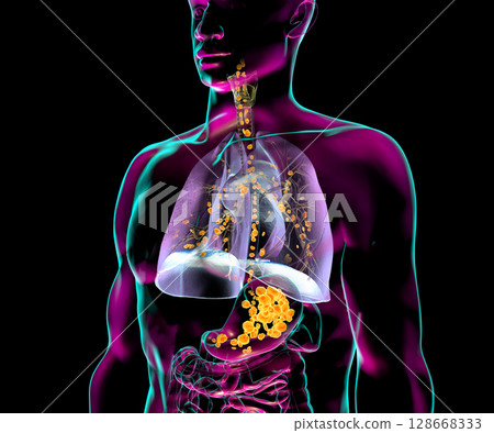 Aspiration pneumonia, 3D illustration 128668333