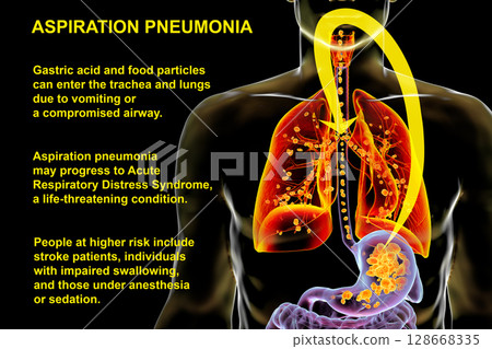 Aspiration pneumonia, 3D illustration Aspiration pneumonia, 3D illustration 128668335