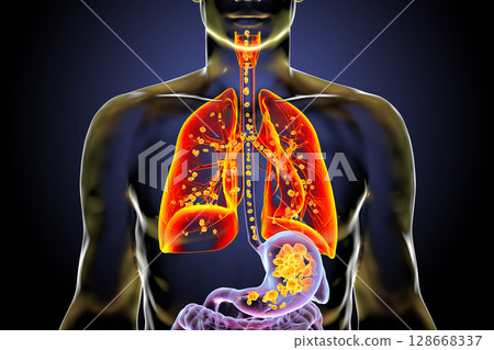 Aspiration pneumonia, 3D illustration 128668337