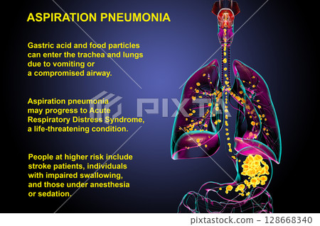 Aspiration pneumonia, 3D illustration Aspiration pneumonia, 3D illustration 128668340