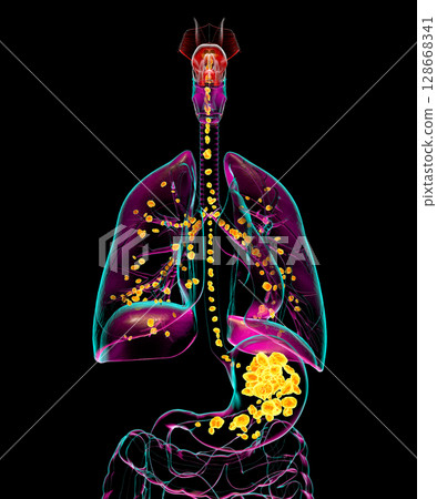 Aspiration pneumonia, 3D illustration 128668341
