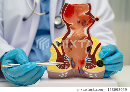 Asian doctor with rectum and hemorrhoid human anatomy model at hospital, inflamed vascular structure. 128698039