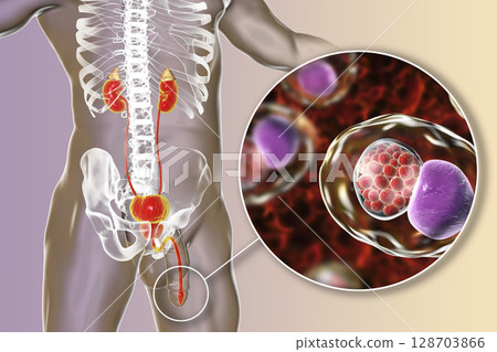 Chlamydiosis infection in man Chlamydiosis infection in man 128703866