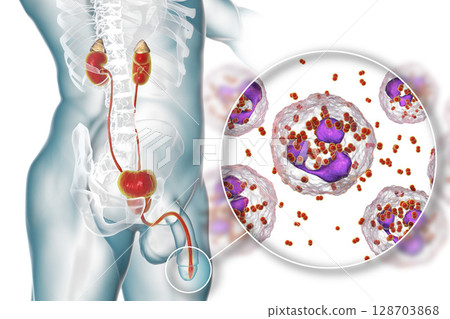 Male gonorrhea, medical concept 128703868