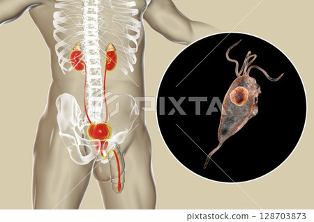 Trichomoniasis infection in man 128703873