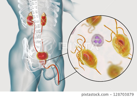 Trichomoniasis infection in man 128703879
