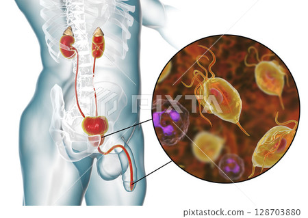 Trichomoniasis infection in man Trichomoniasis infection in man 128703880
