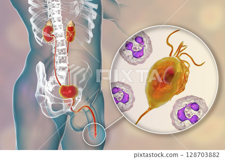 Trichomoniasis infection in man 128703882