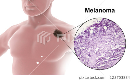 Melanoma on a male body 128703884
