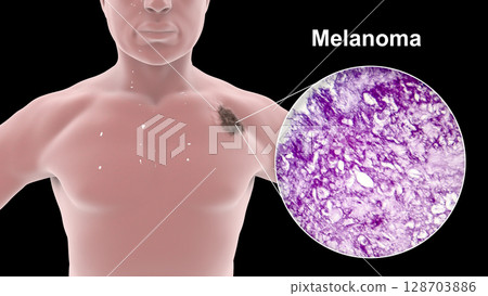 Melanoma on a male body 128703886