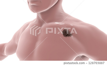 Melanoma on a male body Melanoma on a male body 128703887