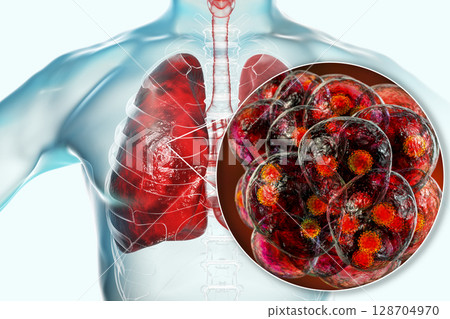 SARS-CoV-2 viruses in alveoli of human lungs causing COVID-19. Novel Coronavirus SARS-CoV-2 viruses in alveoli of human lungs causing COVID-19. Novel Coronavirus 128704970