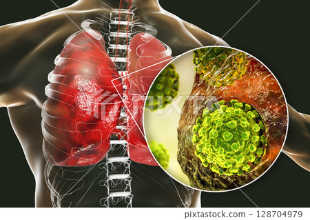 SARS-CoV-2 viruses in alveoli of human lungs causing COVID-19. Novel Coronavirus 128704979