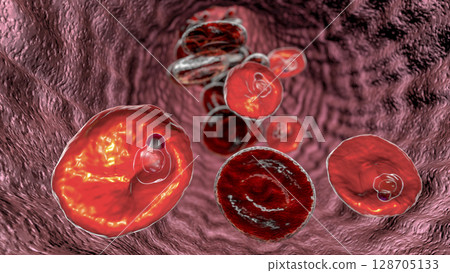 The malaria-infected red blood cell The malaria-infected red blood cell 128705133
