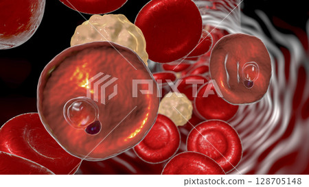 Red blood cell infected with malaria parasite Plasmodium vivax, ring stage 128705148
