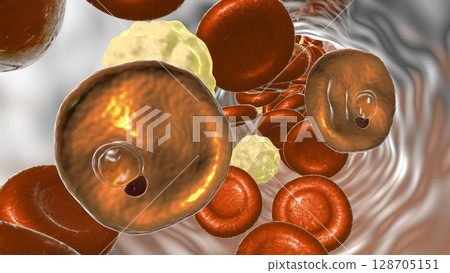Red blood cell infected with malaria parasite Plasmodium vivax, ring stage 128705151