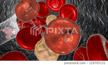 Red blood cell infected with malaria parasite Plasmodium vivax, ring stage 128705152