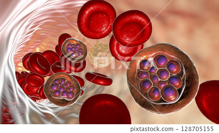 Red blood cell infected with malaria parasite Plasmodium vivax, schizont stage 128705155