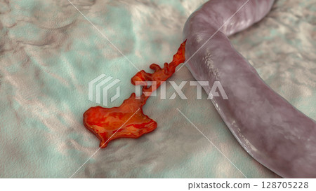 Hemorrhage, blood flowing from the damaged blood vessel, 3D illustration Hemorrhage, blood flowing from the damaged blood vessel, 3D illustration 128705228