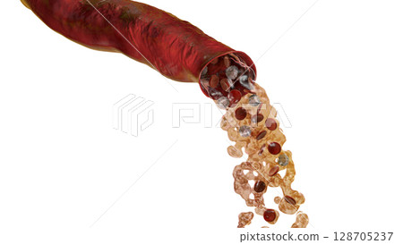 Blood flow, hemorrhage 128705237