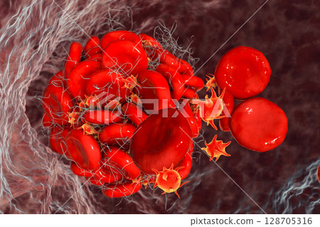 Blood clot made of red blood cells, platelets and fibrin protein strands. Thrombus 128705316