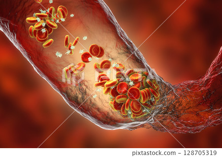 Blood clot made of red blood cells, platelets and fibrin protein strands. Thrombus 128705319