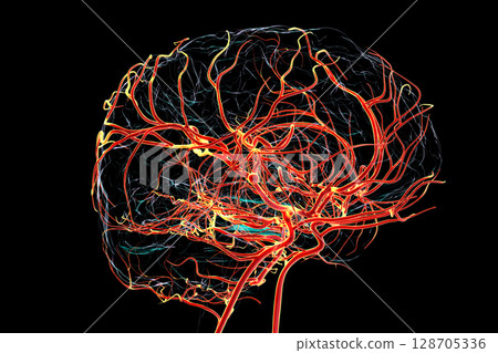 A saccular brain aneurysm, 3D illustration 128705336