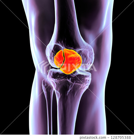 Bipartite patella, a condition where the kneecap has an unfused accessory ossification center, usually superolateral, 3D illustration. Bipartite patella, a condition where the kneecap has an unfused accessory ossification center, usually superolateral, 3D illustration. 128705388