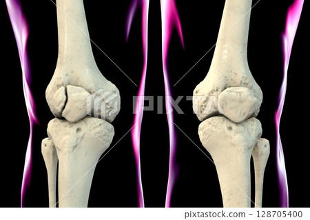 Bipartite patella, a condition where the kneecap has an unfused accessory ossification center, usually superolateral, 3D illustration. Bipartite patella, a condition where the kneecap has an unfused accessory ossification center, usually superolateral, 3D illustration. 128705400