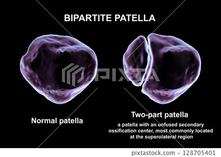 Bipartite patella, a condition where the kneecap has an unfused accessory ossification center, usually superolateral, 3D illustration. 128705401
