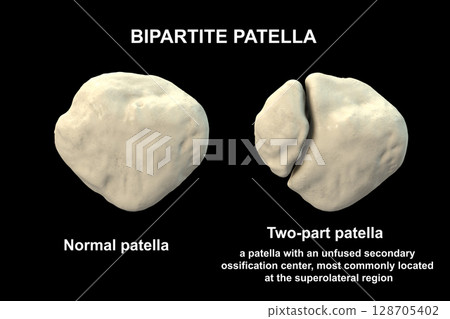 Bipartite patella, a condition where the kneecap has an unfused accessory ossification center, usually superolateral, 3D illustration. Bipartite patella, a condition where the kneecap has an unfused accessory ossification center, usually superolateral, 3D illustration. 128705402